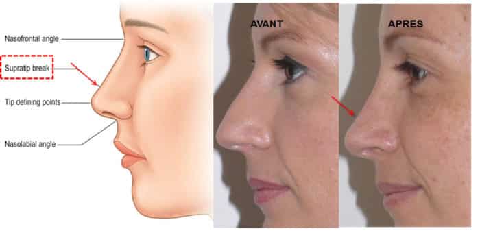 beau résultat rhinoplastie, profil avec dépression sus-apicale