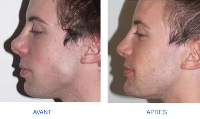 photo de profiloplastie : rhinoplastie et génioplastie