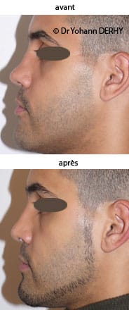 photos rhinoplastie avant-apres