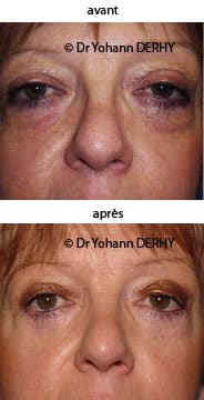 photo blepharoplastie