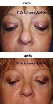 photo blepharoplastie