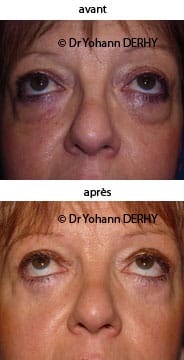 photo blepharoplastie