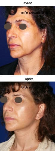 photo lifting visage et cou, botox, lift temporal