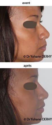 photo rhinoplastie médicale par acide hyaluronique