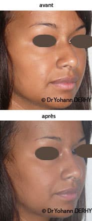 photo rhinoplastie médicale par acide hyaluronique