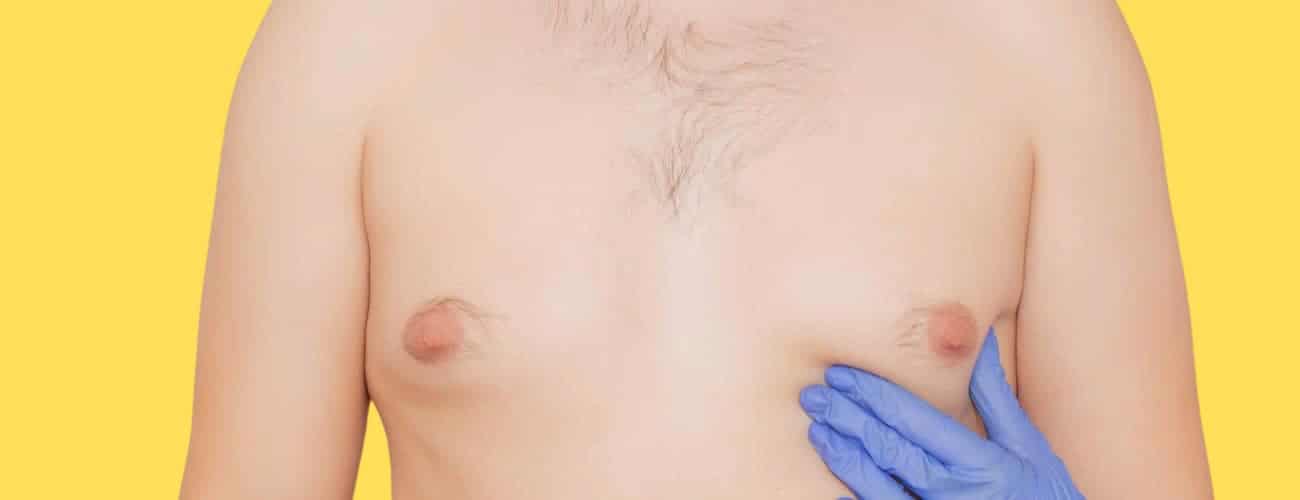 gynecomastie