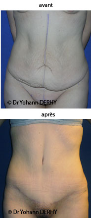 photo abdominoplastie