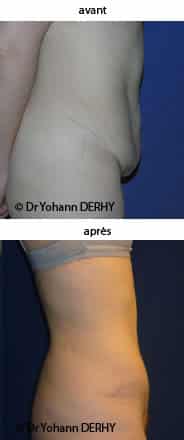 photo abdominoplastie