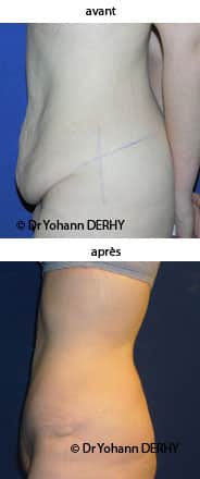 photo abdominoplastie