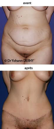 photo abdominoplastie