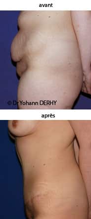 photo abdominoplastie