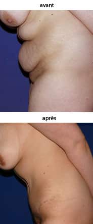 photo abdominoplastie