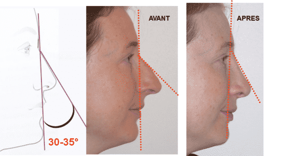 rhinoplastie réussie : angle naso frontal