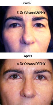 photo blepharoplastie sans cicatrice