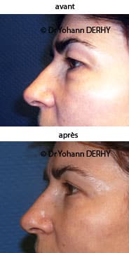 photo blepharoplastie sans cicatrice