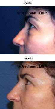 photo blepharoplastie sans cicatrice