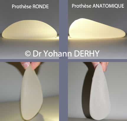 prothèse mammaire ronde en position verticale in vivo