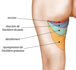 lifting des cuisses technique