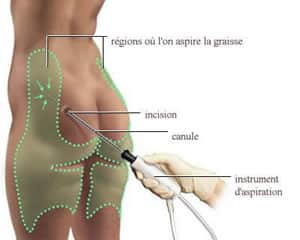 Technique chirurgicale de liposuccion