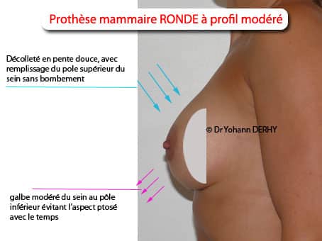 prothèse mammaire ronde profil modéré