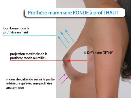 prothèse mammaire ronde profil haut