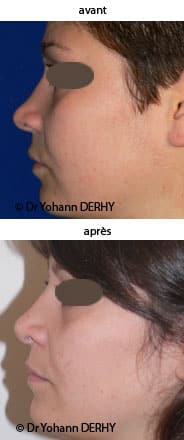 photo rhinoplastie