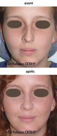 photo rhinoplastie