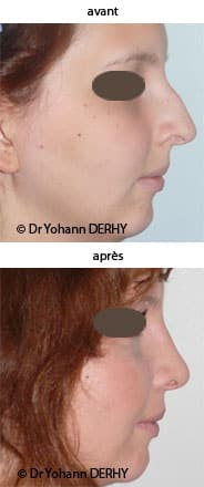 photo rhinoplastie