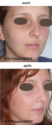 photo rhinoplastie