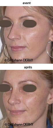 photo rhinoplastie