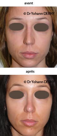 photo rhinoplastie