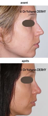 photo rhinoplastie