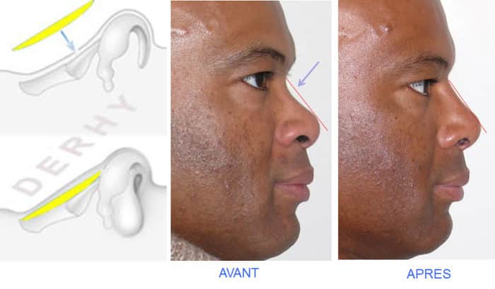 photo avant-après greffe costale pour nez creux