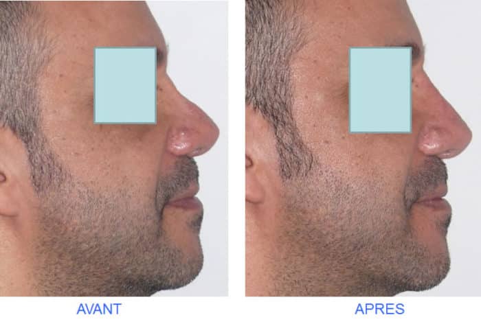 photo avant après nez creux avec ensellure nasale comblée par rhinoplastie médicale avec acide hyaluronique